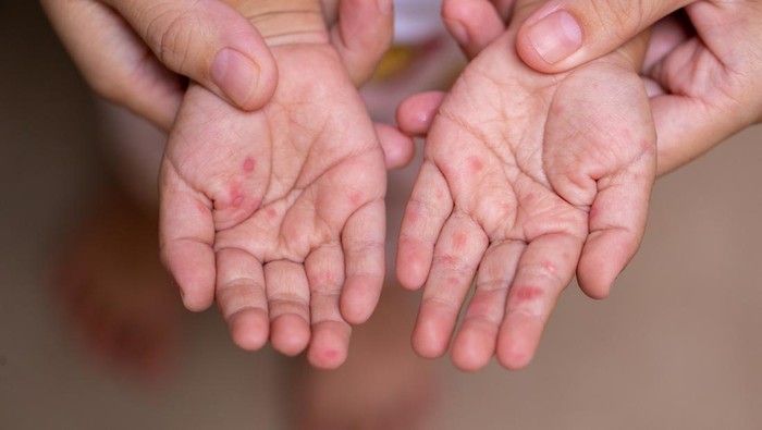 Mudik Lebaran, Dosen UGM Imbau Waspada Penularan Campak pada Anak